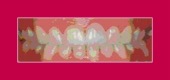 PROPHYLAXIS dental procedures image healthtips images